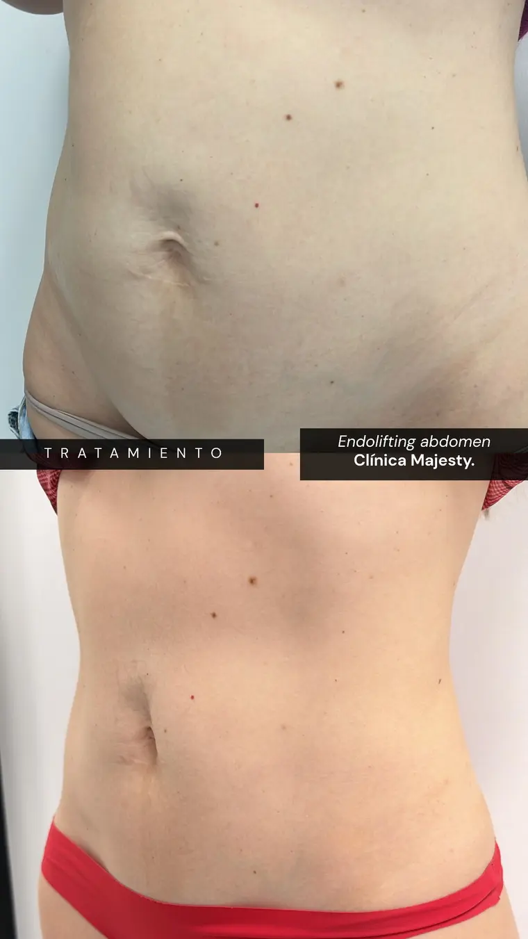 Antes y después de endolifting en abdomen en una paciente de Clínica Majesty