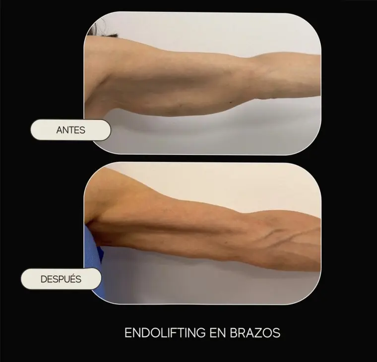 Antes y después de endolifting en brazos en una paciente de Clínica Majesty