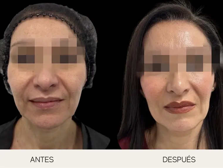 Antes y después de endolifting facial de frente en una paciente de Clínica Majesty