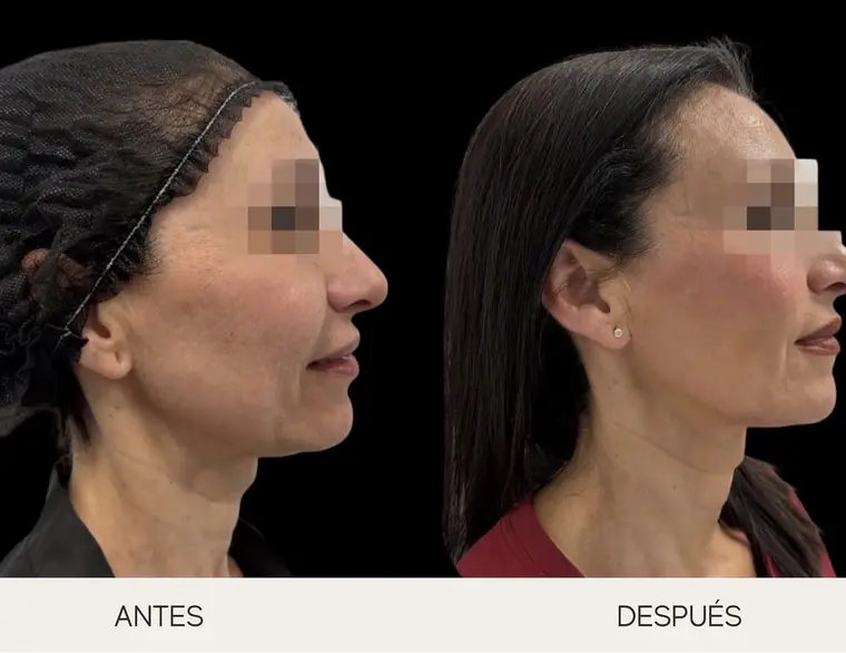 Antes y después de endolifting facial de perfil: óvalo y cuello más definidos
